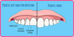 desgaste dental masajes León